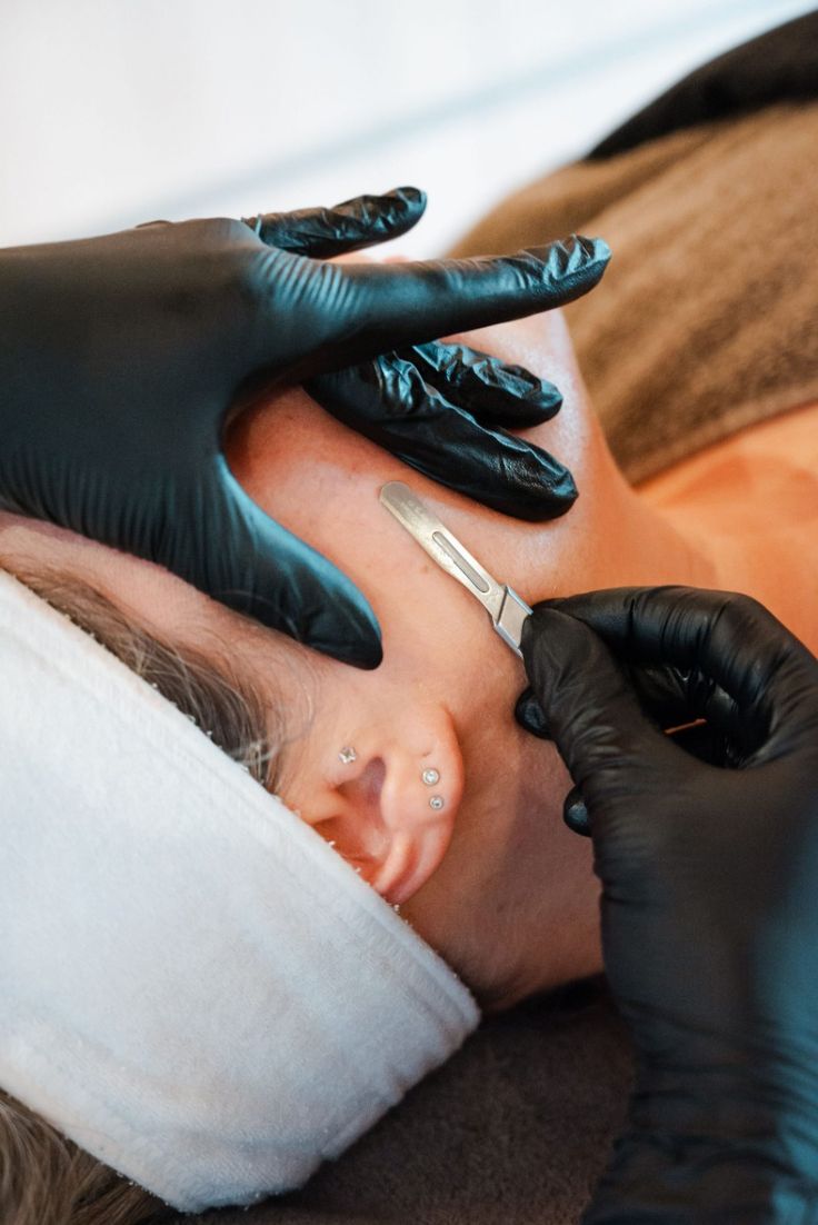 Dermaplaning treatment